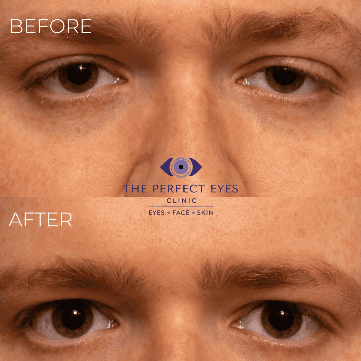 Ptosis surgery before and after, case 6, by Dr Sabrina Shah-Desai