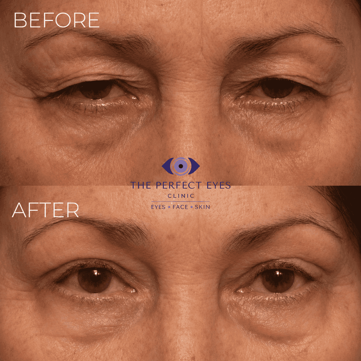 Ptosis surgery before and after, case 7, by Dr Sabrina Shah-Desai