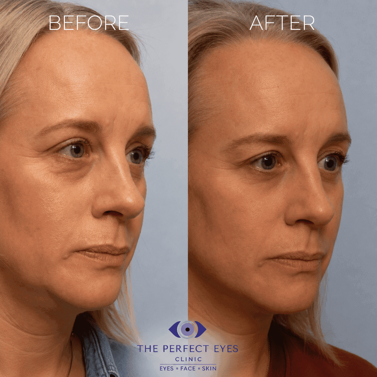 Ptosis surgery before and after, case 9, by Dr Sabrina Shah-Desai