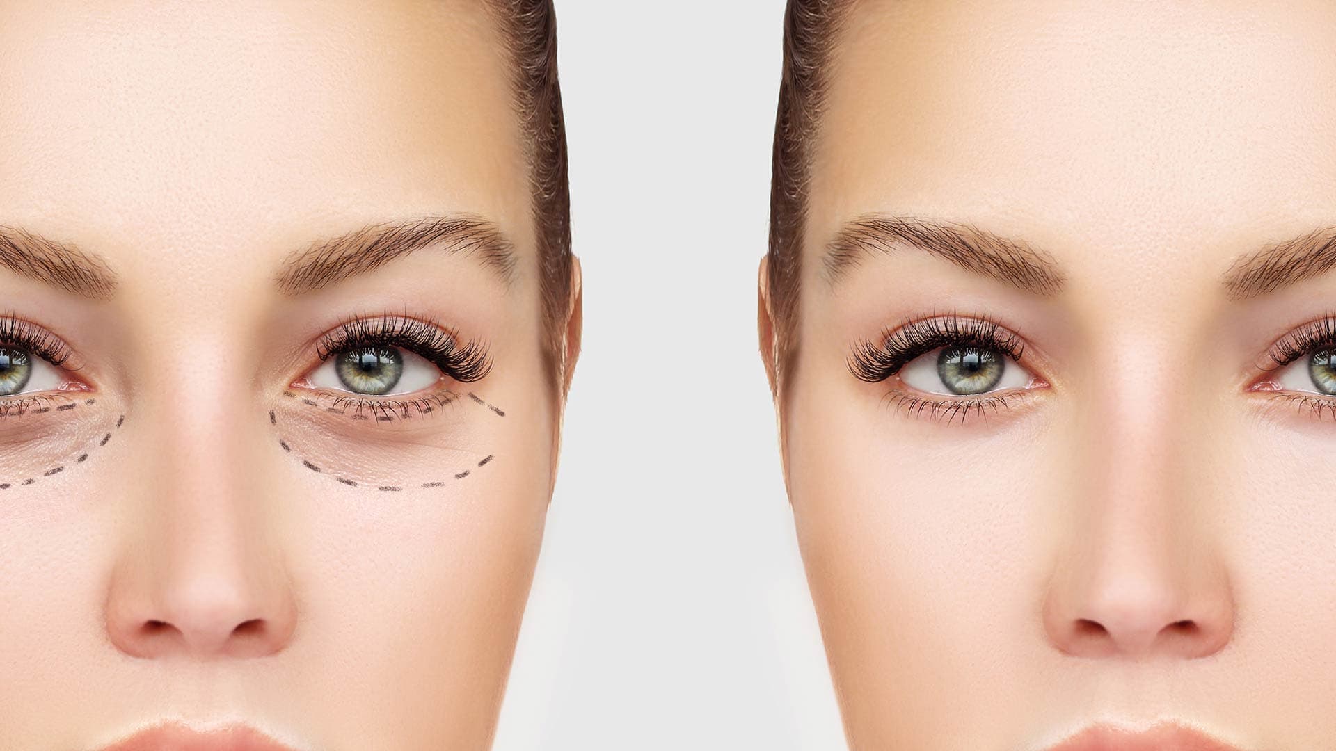 Eye bag surgery