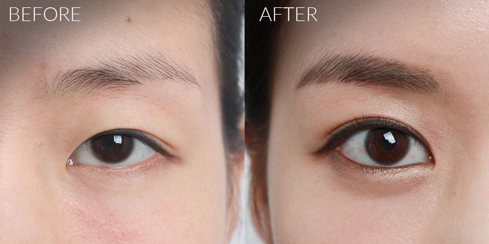 Double eyelid surgery before and after - eyebrow and eye crease