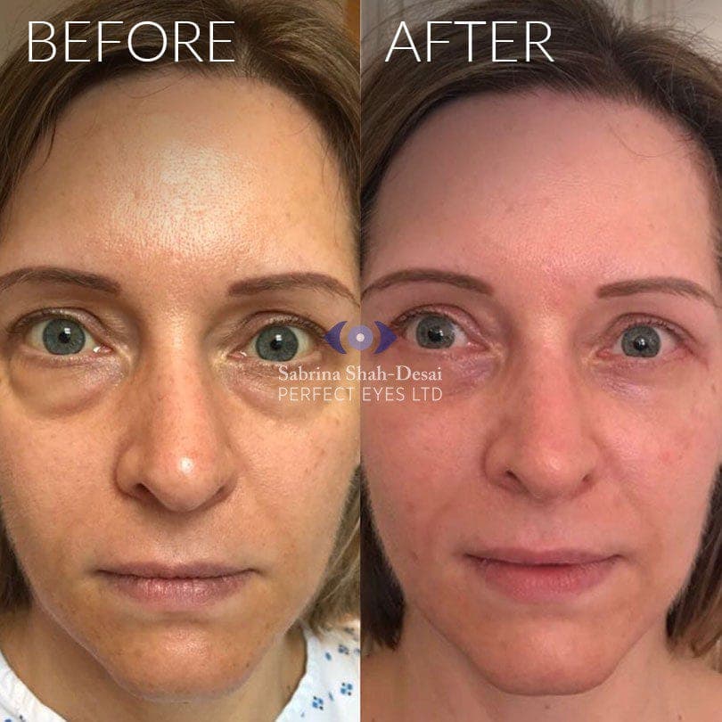 Lower lid blepharoplasty before and after