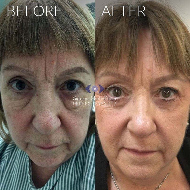 Lower lid blepharoplasty before and after