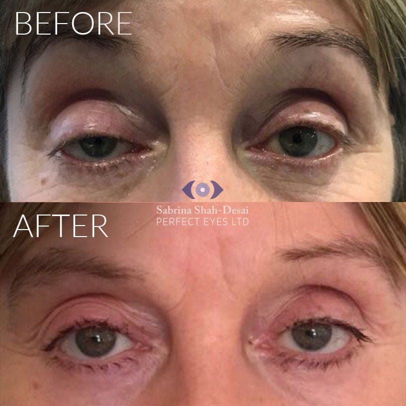 Upper lid blepharoplasty before and after