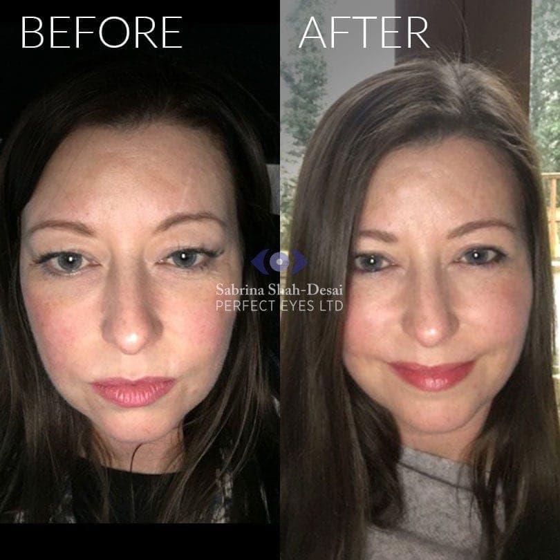 Upper lid blepharoplasty before and after