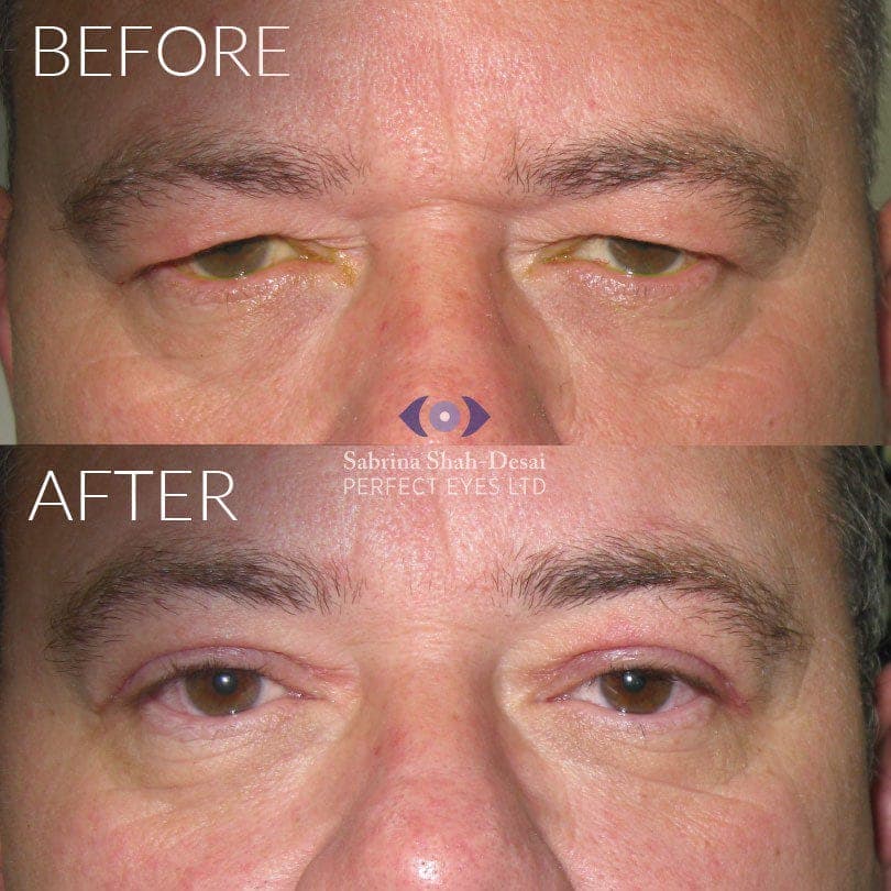 Upper lid blepharoplasty before and after
