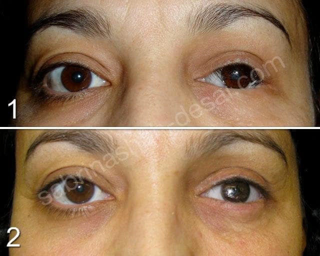 Artificial Eyes and Orbital Implants before and after, a patient of Dr Sabrina Shah-Desai