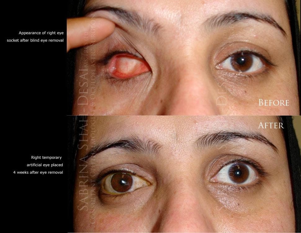 How Orbital Implants Restore the Eye Socket