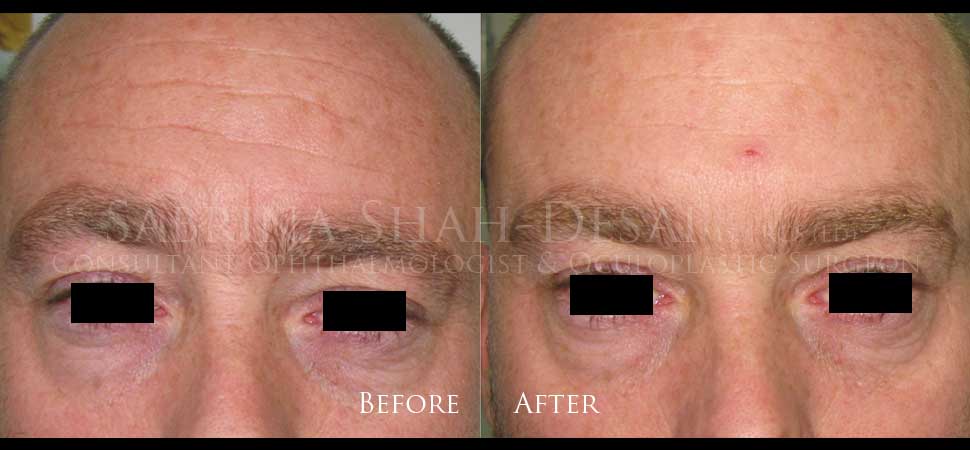 Brow lift before and after result