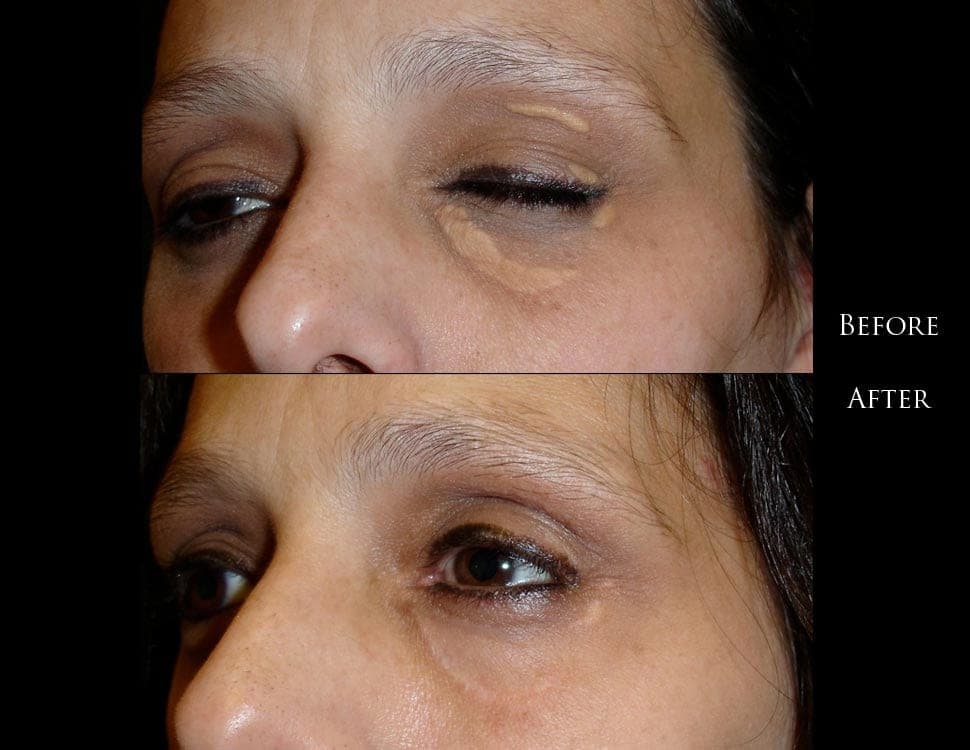 Eyelid lump surgery before and after result