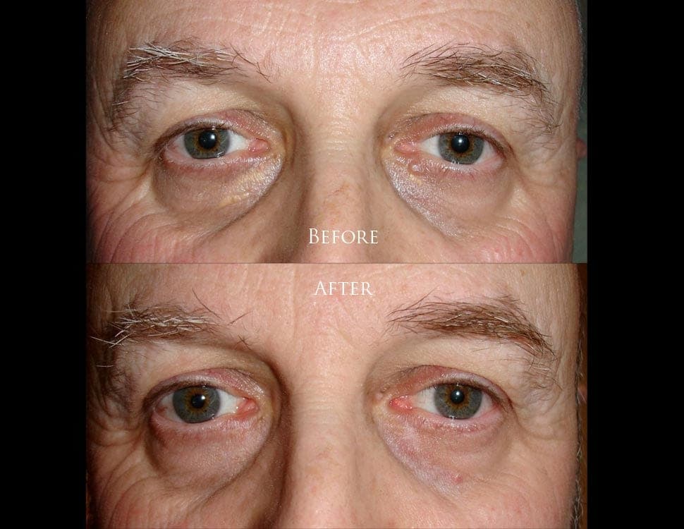 Eyelid lump surgery before and after result