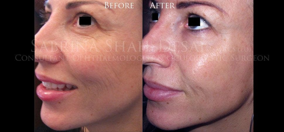 Microdroplet injection before and after result