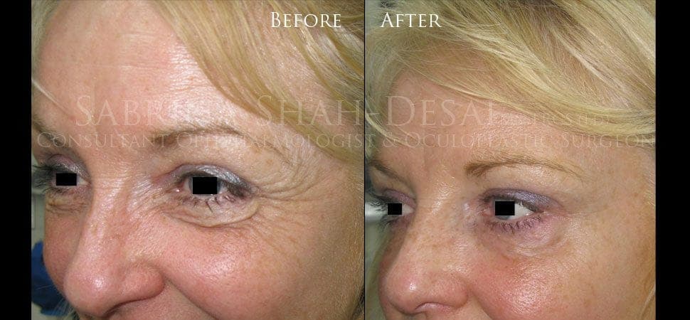 Microdroplet injection before and after result