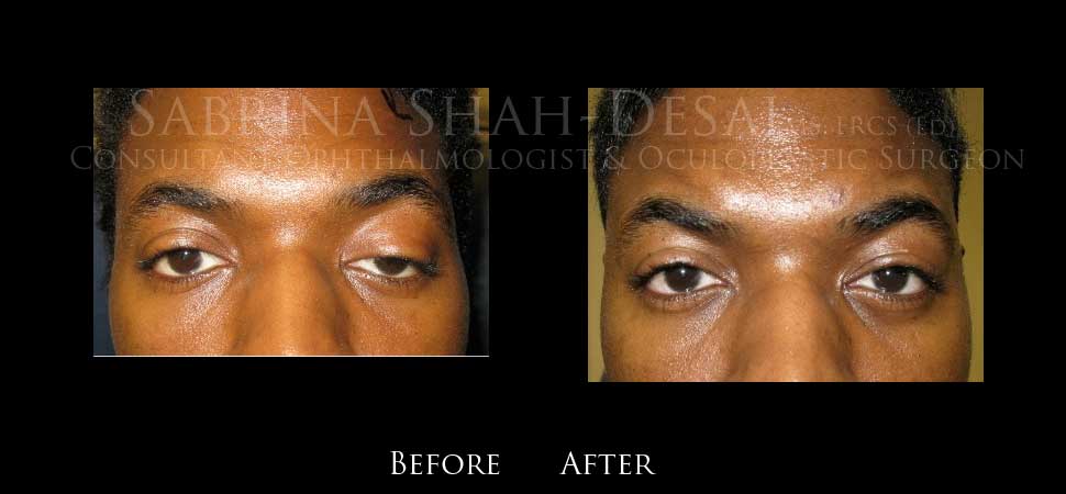 Brow suspension ptosis surgery before and after - case 1