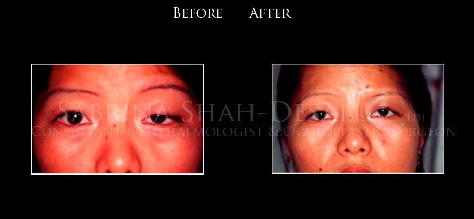 Brow suspension ptosis surgery before and after - case 2