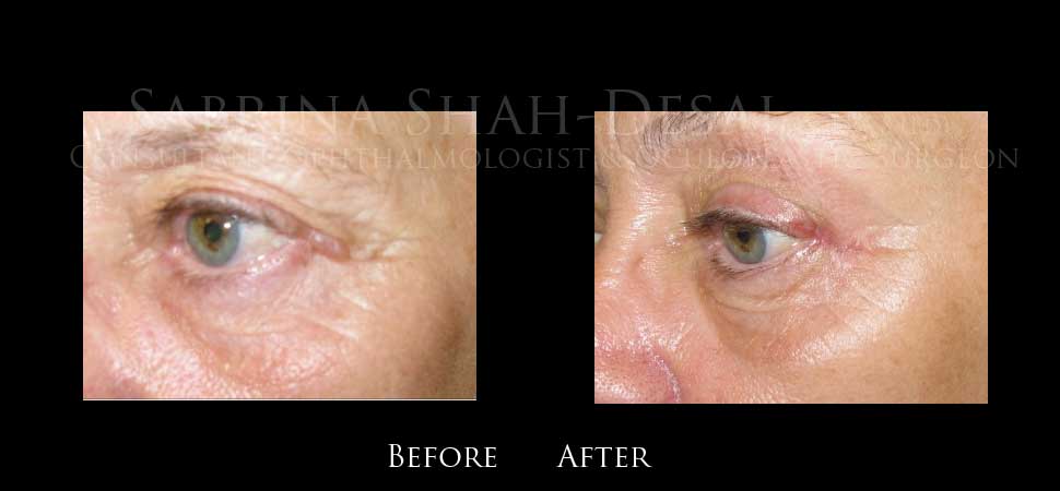 Eyelid lumps and bumps before and after result