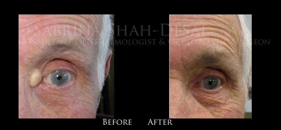 Eyelid lumps and bumps before and after result
