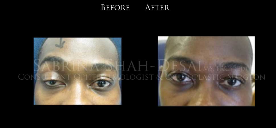 Ptosis surgery before and after - case 2