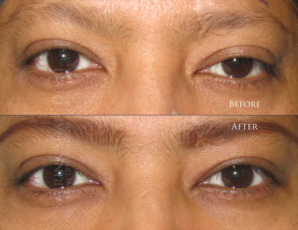 Scarless ptosis surgery before and after - case 1
