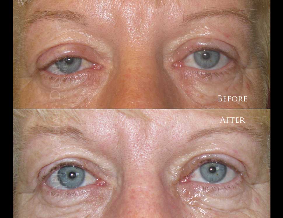 Scarless ptosis surgery before and after - case 2