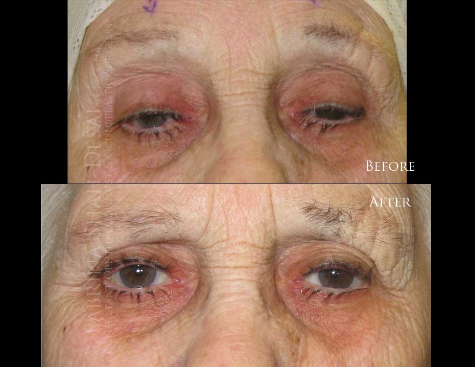 Scarless ptosis surgery before and after - case 3