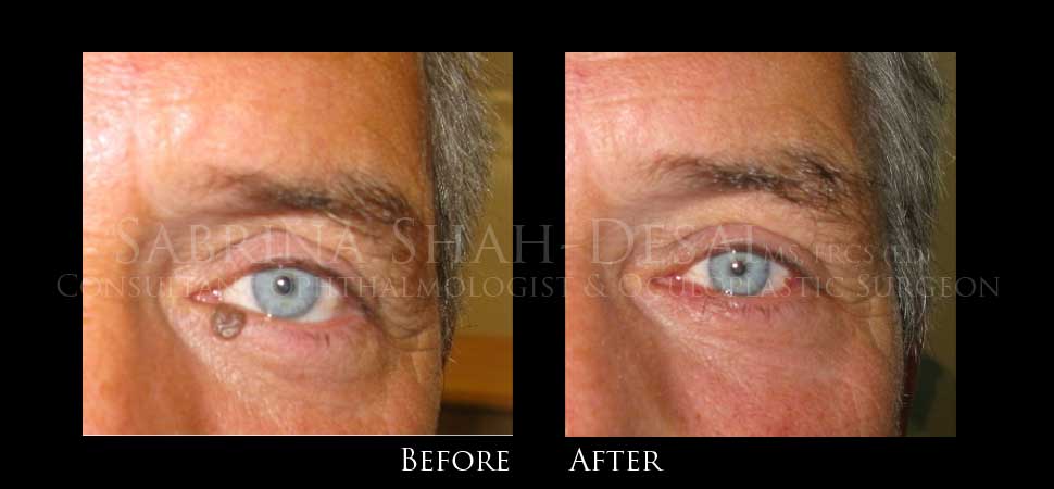 Papilloma / seborrhoeic keratoses before and after result