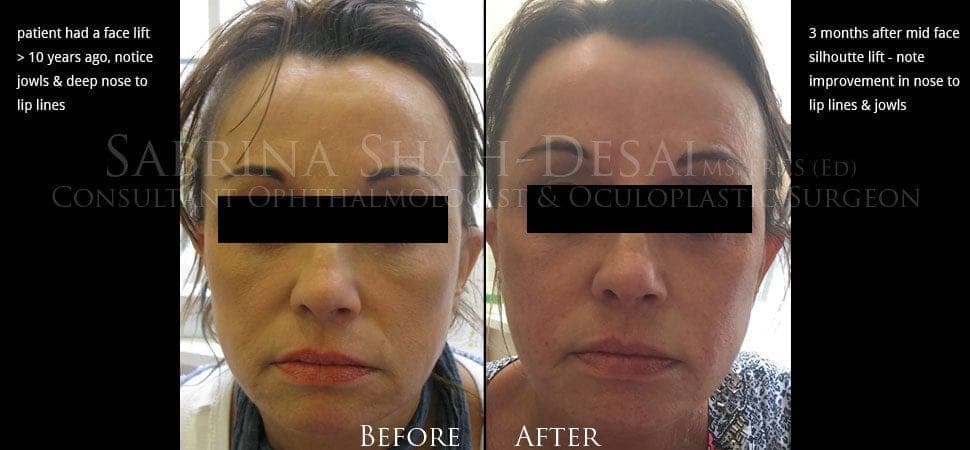 Silhouette Soft thread lift before and after result