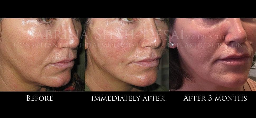 Silhouette Soft thread lift before and after result