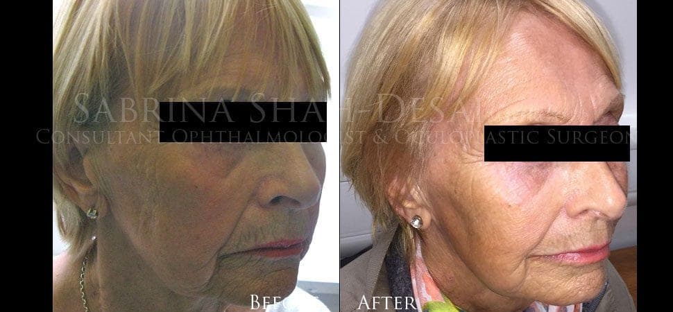 Silhouette Soft thread lift before and after result