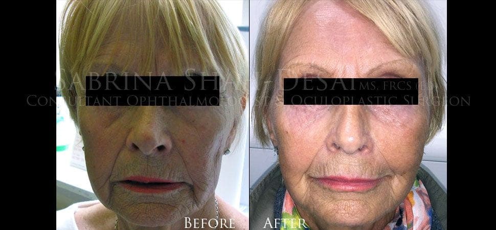 Silhouette Soft thread lift before and after result