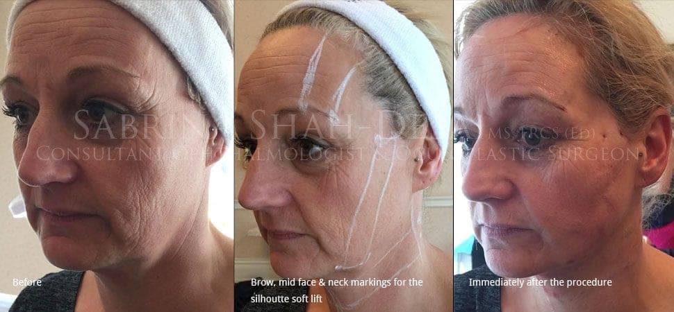 Silhouette Soft thread lift before and after result