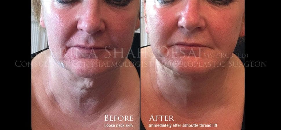 Silhouette Soft thread lift before and after result