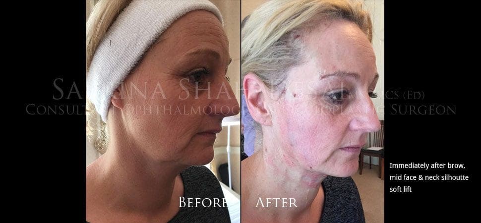 Silhouette Soft thread lift before and after result