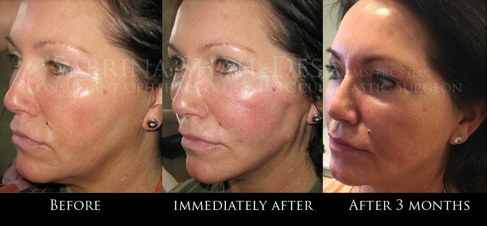 Silhouette Soft thread lift before and after result