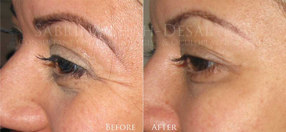 Microdroplet Injection before and after, a patient of Dr Sabrina Shah-Desai