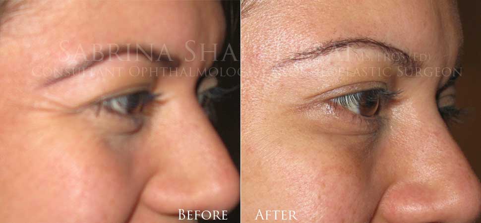 Wrinkle treatment before and after result