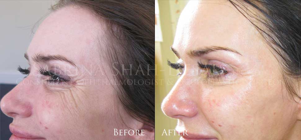 Wrinkle treatment before and after result
