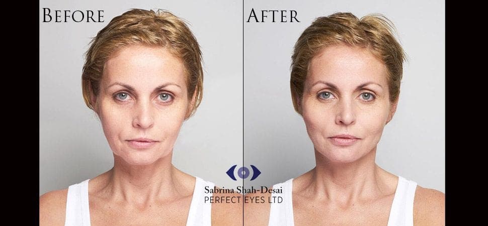 Silhouette Soft thread lift before and after result