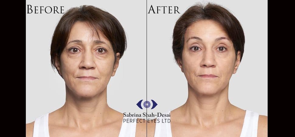 Silhouette Soft thread lift before and after result