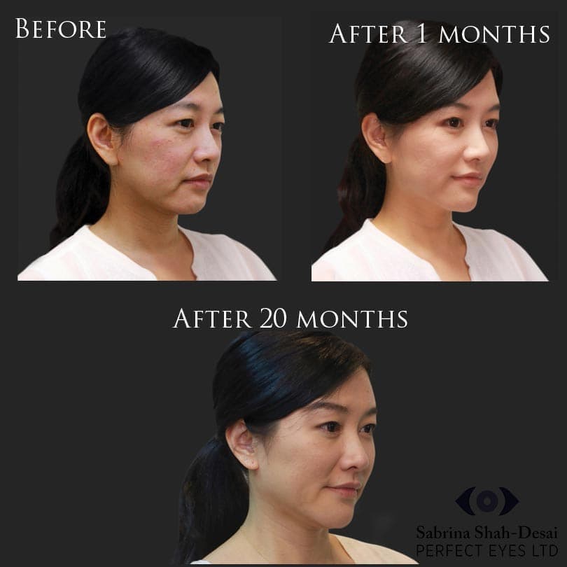 Biostimulation before and after result