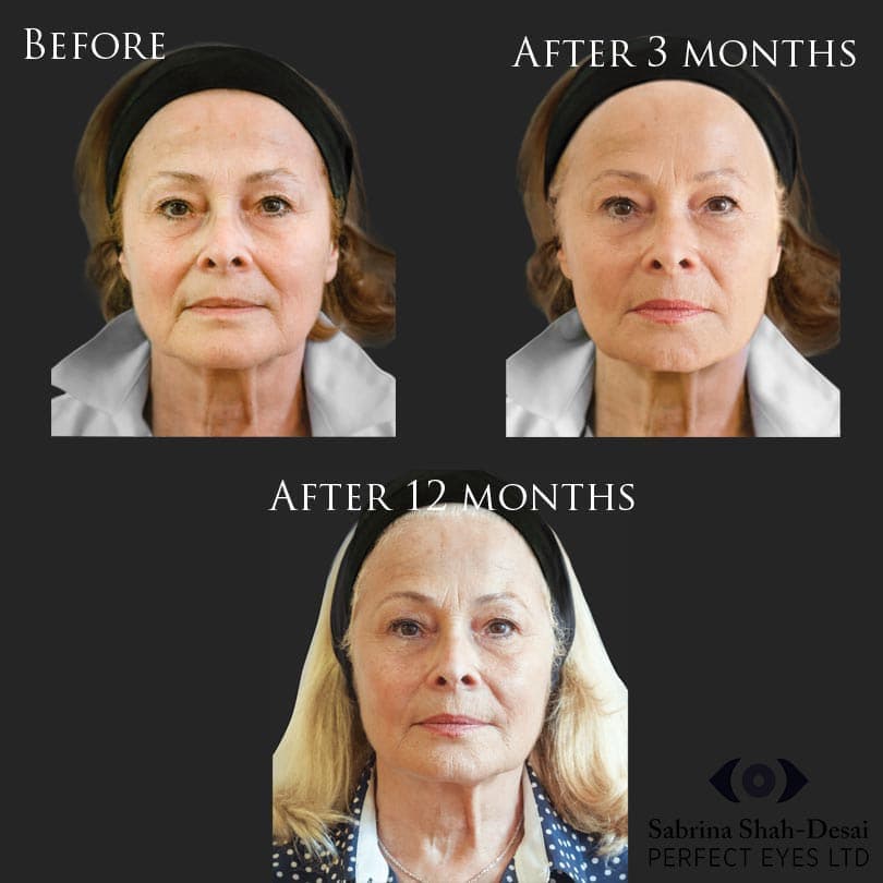 What is Biostimulation Filler?