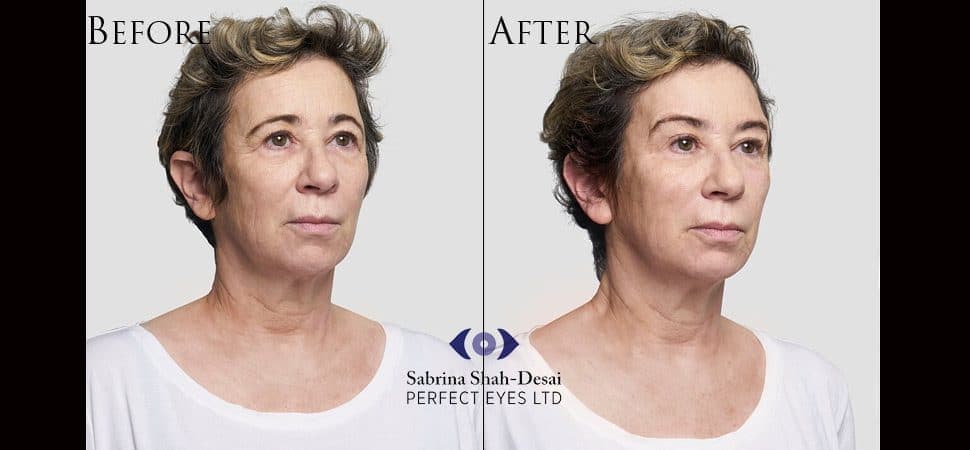 Silhouette Soft thread lift before and after result