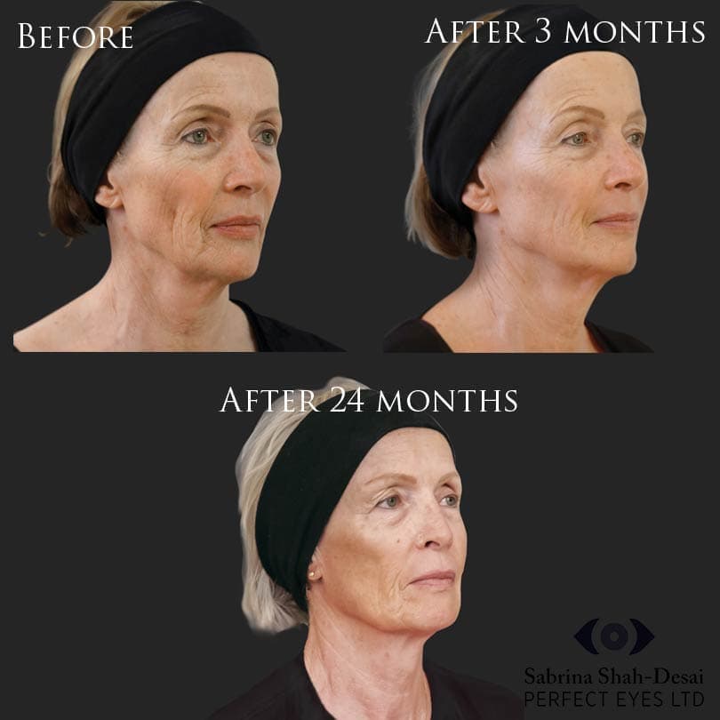 Biostimulation before and after result