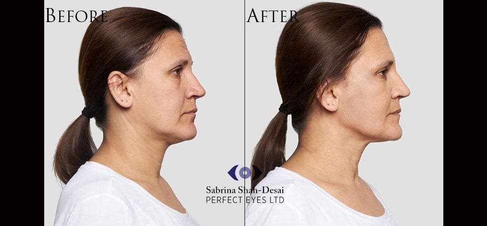 Silhouette Soft thread lift before and after result