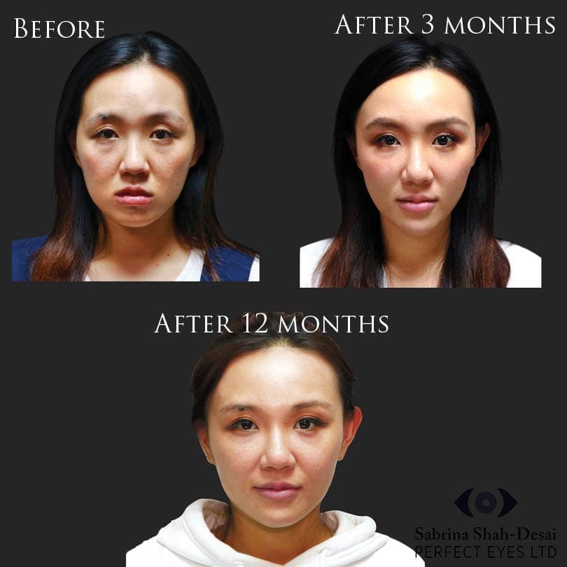 Biostimulation before and after result