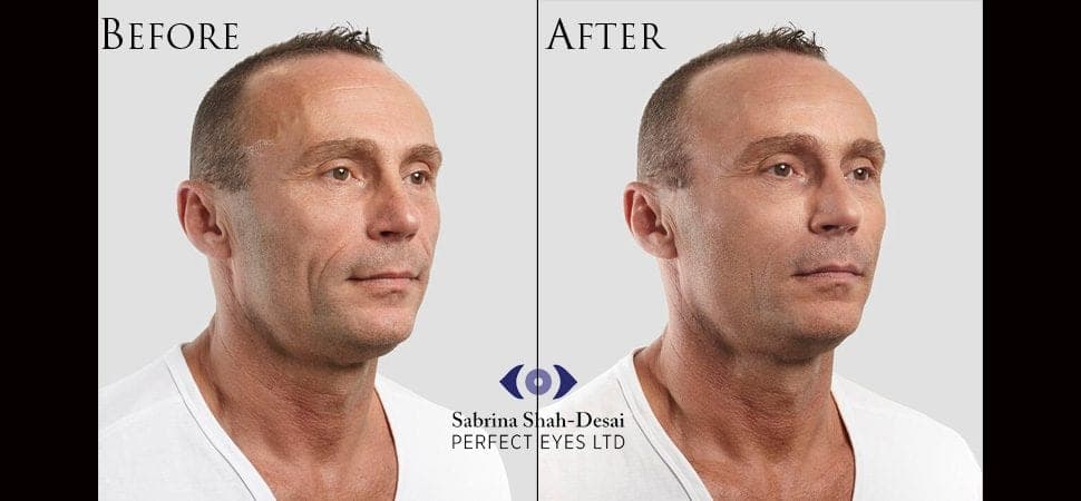 Silhouette Soft thread lift before and after result