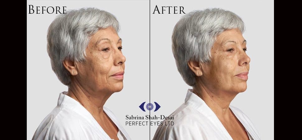 Silhouette Soft thread lift before and after result