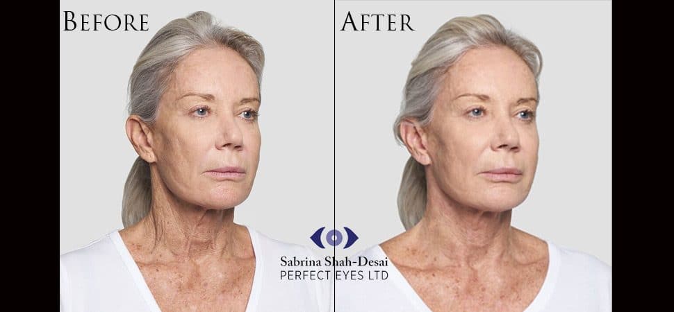 Silhouette Soft thread lift before and after result
