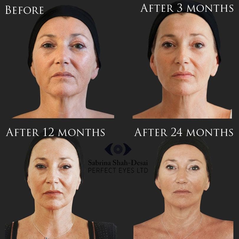 Biostimulation before and after result