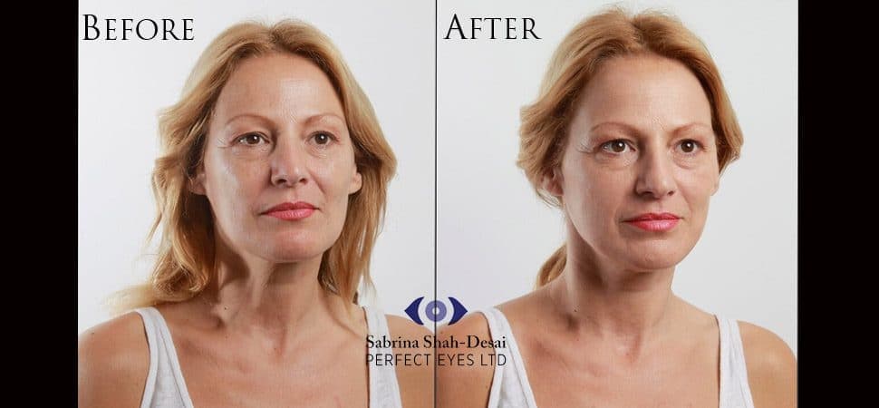 Silhouette Soft thread lift before and after result